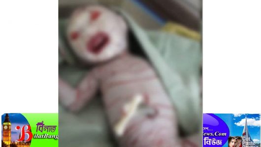 চট্টগ্রামে ডোরাকাটা দাগ ও প্লাস্টিকের মতো চামড়ায় ঢাকা বিরল শিশুর জন্ম